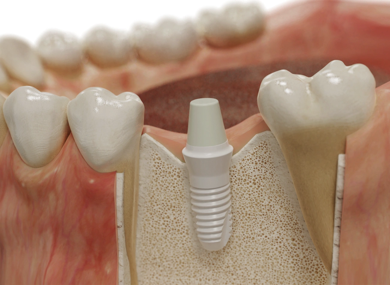3-D Modell eines Gebisses mit einem Keramikimplantat