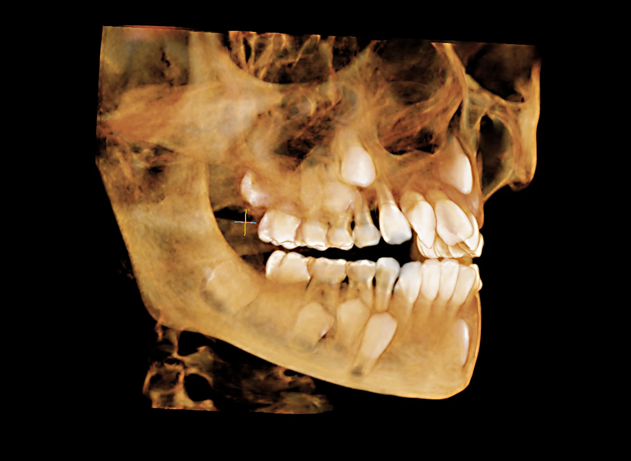 Abbildung einer 3D-Rekonstruktion aus einer digitalen Volumentomographie (DVT) bzw. einem Cone-Beam-CT des Schädels im seitlichen (lateralen) Anschnitt.
